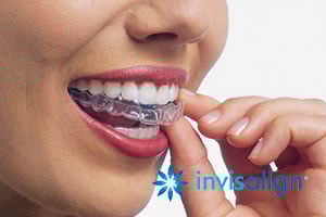Invisalign®